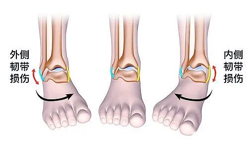 【醫療科普】之為什么說踝關節骨折手術復雜？