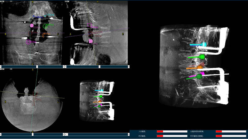 機器人輔助腰椎后路側(cè)彎矯形手術(shù)三維圖像