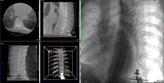 機器人做胸椎手術影像